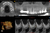 Fig 5. CBCT revealed residual bone height less than 6 mm.