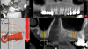 Fig 6. Realtime
tracking of osseodensification bur upfracturing sinus floor but
not exceeding 3 mm. Red depth control indicator and bull’s eye target
deliver real-time feedback to position.