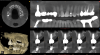 Fig 8. CBCT at 3-year follow-up
showed new sinus floor and implant surrounded by bone. MAR feature
was used to remove metal scatter.