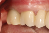 Fig 9. Final screw-retained implant
crown 3 years postoperative.