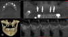 Fig 10. CBCT revealed relatively non-complex implant placement on
the maxillary right side for the maintenance of 3 mm between each
implant and less than 6 mm residual bone height on the maxillary left
side.