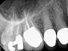 Fig 2. Case 1: Periapical imaging of the maxillary right (Fig 2) and mandibular right (Fig 3) quadrants initially showed no obvious pathology, aside from the horizontally impacted tooth No. 32. Secondary imaging following successful relief of pain after administration of an inferior alveolar nerve block revealed pre-eruptive intracoronal resorption in tooth No. 32 with resultant symptomatic irreversible pulpitis as the likely source of pain (Fig 4).