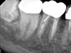 Fig 3. Case 1: Periapical imaging of the maxillary right (Fig 2) and mandibular right (Fig 3) quadrants initially showed no obvious pathology, aside from the horizontally impacted tooth No. 32. Secondary imaging following successful relief of pain after administration of an inferior alveolar nerve block revealed pre-eruptive intracoronal resorption in tooth No. 32 with resultant symptomatic irreversible pulpitis as the likely source of pain (Fig 4).