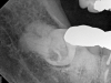 Fig 4. Case 1: Periapical imaging of the maxillary right (Fig 2) and mandibular right (Fig 3) quadrants initially showed no obvious pathology, aside from the horizontally impacted tooth No. 32. Secondary imaging following successful relief of pain after administration of an inferior alveolar nerve block revealed pre-eruptive intracoronal resorption in tooth No. 32 with resultant symptomatic irreversible pulpitis as the likely source of pain (Fig 4).