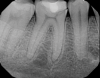 Fig 6. Case 2: Periapical imaging of the maxillary right (Fig 5) and mandibular right (Fig 6) quadrants.