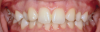 Fig 1. Patient was missing teeth Nos. 7 and 10 (Fig 1). Canine substitution was the treatment used to replace these missing teeth (Fig 2).