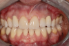 Fig 4. A 15-year postoperative photograph of the patient in Fig 3 illustrates the significant infraocclusion of the implants compared to the natural teeth. Also, note the blue tissue discoloration over implants Nos. 7 and 11.