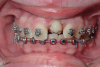 Fig 7. Six weeks postoperative, after autotransplantation of tooth No. 20 into site No. 9.