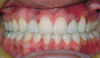 Fig 14. Porcelain crown on TAD in site No. 7 at 99-month postoperative follow-up. No impediment of vertical growth was evident.