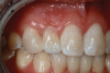 Fig 15. Four-year postoperative photograph of zirconia bonded bridge replacing tooth No. 7.