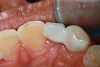 Fig 16. Occlusal view of the zirconia bonded bridge in Fig 15 at 4-year postoperative showing one wing on the canine abutment and a small anti-rotation extension from the pontic onto the distolingual surface of tooth No. 8.