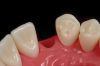 Fig 17. Ideal preparation with boxform retention on mesial of canine.