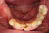 Fig 2. A 75-year-old man presenting with a terminal dentition. The patient requested complete dentures with implant retention.