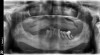 Fig 3. Radiograph showing extensive periodontal disease. After being presented with the option to have two or four implants, the patient chose to have two implants. Because he wanted the option to have additional implants in the future, the implants were placed in regions that would permit placement of additional implants.