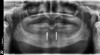 Fig 4. Teeth were extracted and implants placed in the B and D positions of the interforaminal portion of the anterior mandible.