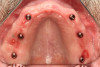Fig 9. Definitive stud-style abutments (LOCATOR R-Tx, Zest Dental Solutions) were placed onto the mandibular implants.
