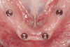 Fig 13. Radio-graph confirming the positions and health of the existing implants before the conversion to a fixed prosthesis.