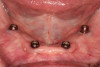 Fig 16. An optical scanner (TRIOS® 3, 3Shape) was then used to capture a digital impression of the housings on the fixed abutments.