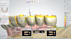 Fig 18. The prosthesis was digitally produced and housings attached intraorally using a composite resin (CHAIRSIDE Attachment Processing Material, Zest Dental Solutions). Medium-strength definitive retention inserts were placed.