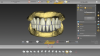 Fig 2. Complete denture design.