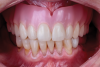 Fig 9. Immediate denture at delivery appointment.