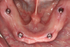 Fig 5. Mandibular overdenture abutments were placed. Fig 5. Mandibular overdenture abutments were placed.