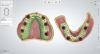 Fig 8. Maxillary (left) and mandibular (right) overdenture frameworks were designed using a laboratory software. The framework designs would be 3D printed using cobalt-chrome.