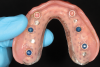 Fig 11. Processing inserts were replaced with definitive nylon inserts.