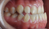 Fig 3. Pretreatment dental views of the patient; right lateral view (Fig 3), frontal view (Fig 4), and left lateral view (Fig 5).