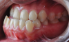 Fig 5. Pretreatment dental views of the patient; right lateral view (Fig 3), frontal view (Fig 4), and left lateral view (Fig 5).