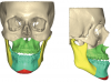 Fig 9. Through virtual surgical planning the surgeon can obtain guides used during surgery to allow millimetric precision of the surgical results.
