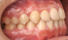 Fig 13. Dental views of the patient 3 years after surgical-orthodontic correction; right lateral view (Fig 13), frontal view (Fig 14), and left lateral view (Fig 15).