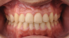 Fig 14. Dental views of the patient 3 years after surgical-orthodontic correction; right lateral view (Fig 13), frontal view (Fig 14), and left lateral view (Fig 15).