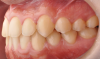 Fig 15. Dental views of the patient 3 years after surgical-orthodontic correction; right lateral view (Fig 13), frontal view (Fig 14), and left lateral view (Fig 15).