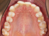 Fig 4. Preoperative intraoral occlusal views of the maxillary (Fig 4) and mandibular (Fig 5) arches.