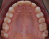 Fig  6. Intraoral occlusal views of the maxillary (Fig 6) and mandibular (Fig 7) arches after tooth extractions and orthodontic treatment.