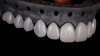 Fig 15. The CAD/CAM milled restorations after staining and glazing.