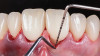 Fig 17. Crown lengthening with 
ultrasonic diamond instruments to create the 
proper biologic width and symmetric gingival contours.