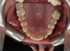 Fig 3. Extra-oral photography. All dental practices should provide the patient with the following four extra-oral photographs: the close-up smile (Fig 1), the retracted smile (Fig 2), the upper arch (Fig 3), and the lower arch (Fig 4).