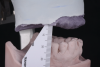 Fig 2. Prosthetic space measured from the soft-tissue height of the edentulous ridge to the occlusal surface of the opposing dentition across the arch.