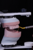 Fig 3. Prosthetic space measured using millimeter probe on mounted casts.