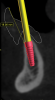 Fig 5. Radiographic measurements to establish the amount of prosthetic space available; these measurements aid in planning prosthetic space and implant placement. Fig 4 demonstrates a method to measure the apico-coronal dimensions of the restorative prosthesis. Fig 5 allows for assessment of the implant position planned based on radiographic bone volume and prosthesis positions.