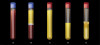 Fig 8. 5G PRP protocol. Step 1: After collection of blood in vacuum-loaded tube (A), first centrifuge spin (150 g-force for 15 minutes) separates blood into three layers (B): red blood cells (bottom portion of tube, red), leukocytes (middle portion of tube, white), and plasma with platelets (upper portion of tube, yellow). Step 2: The yellow portion was removed from the blue-capped tube and placed in dry red-capped tubes and recentrifuged, at 300 g-force for 10 minutes. After this second centrifuge spin all platelets will be at the bottom of the tube (C). Note the darker yellow color at the bottom of tube C signifying platelets. Step 3: 50% of the plasma is removed from the recentrifuged tube with the platelets remaining at the bottom of the tube (D). Step 4: The tube is gently shaken to resuspend the platelets in the remaining plasma (E).