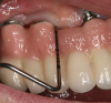 Fig 1. Probing is essential in monitoring the health of peri-implant
tissues. The design of this maxillary hybrid prosthesis interferes with
circumferentially probing the implants.