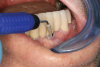 Fig 3. Ultrasonic insert with
nylon tip can be used for debriding implant abutment surface.