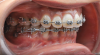 Fig 1. Example of a class II mandibular advancement patient decompensated through the use of buccal shelf temporary anchorage devices (TADs). The lower arch was fully retracted. Overjet was obtained for the surgical correction. Fig 1: Before orthodontic decompensation. Fig 2: After orthodontic decompensation.