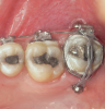 Fig 3. TAD-assisted intrusion. Buccal and palatal TADs were used to intrude an overextruded molar in a class II surgical patient.