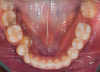 Fig 4. Miniplate in the lower posterior used to perform alignment of a very crowded lower arch during preparatory orthodontics for a class III adult female patient requiring double jaw surgery. Fig 4: Crowding present before presurgical orthodontics. Fig 5: Crowding corrected using the miniplate as anchorage.