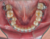 Fig 5. Miniplate in the lower posterior used to perform alignment of a very crowded lower arch during preparatory orthodontics for a class III adult female patient requiring double jaw surgery. Fig 4: Crowding present before presurgical orthodontics. Fig 5: Crowding corrected using the miniplate as anchorage.