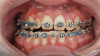 Fig 6. An asymmetric class III patient decompensated through the use of TADs in both arches. Fig 6: A previous compensatory treatment from another orthodontist. Fig 7: Case was decompensated with the use of TADs. Note occlusal plane correction and teeth that are now upright over their basal bone in preparation for orthognathic surgery, producing a full left posterior crossbite as a consequence of decompensation.